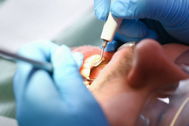 Best Knocked-Out Tooth (Avulsed Tooth) Treatment in Waverly, VA